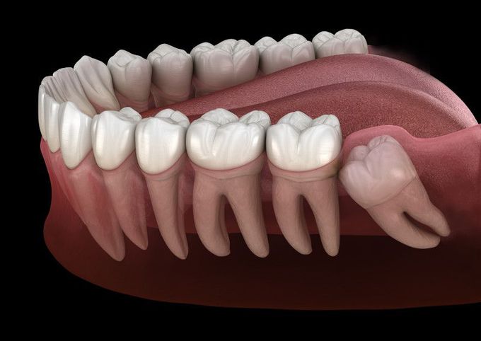 The wisdom behind wisdom teeth!