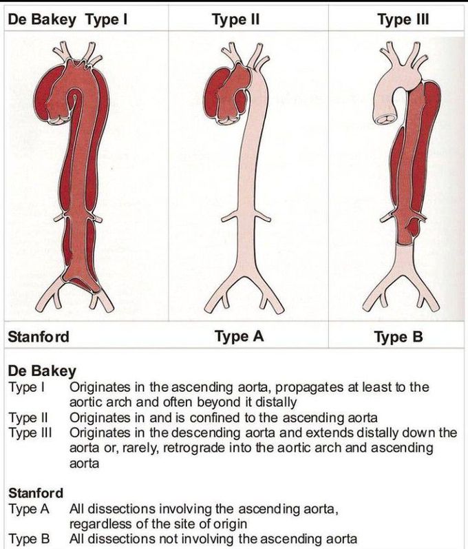 De bakey's classification of aortal dissection