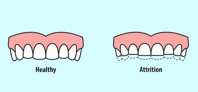Dental attrition