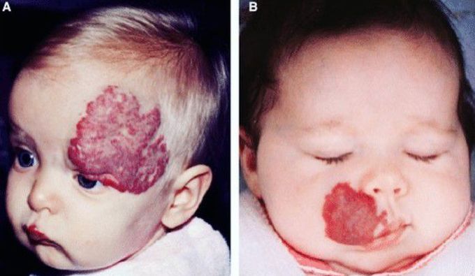 Strawberry Hemangioma