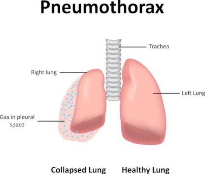 Pneumothorax