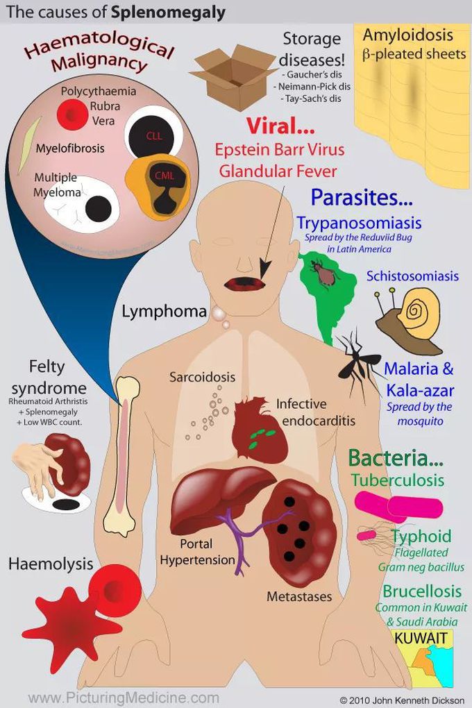 CAuses Of sPlenomeGaly