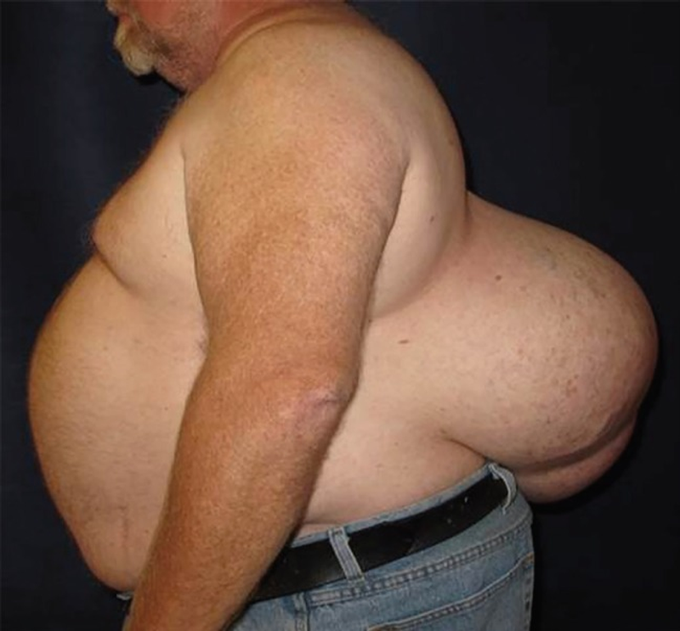 14 Kg Subcutaneous Lipoma Untreated For 20 Years