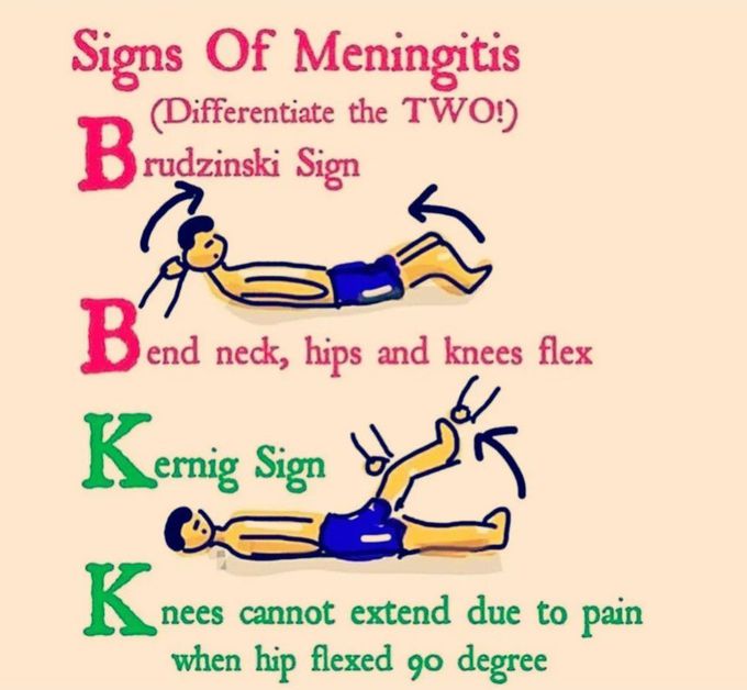 Signs of Meningitis