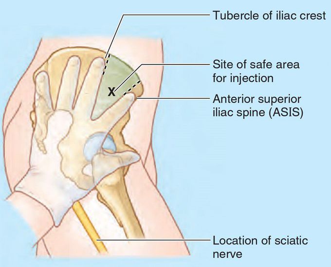 Intragluteal Injections