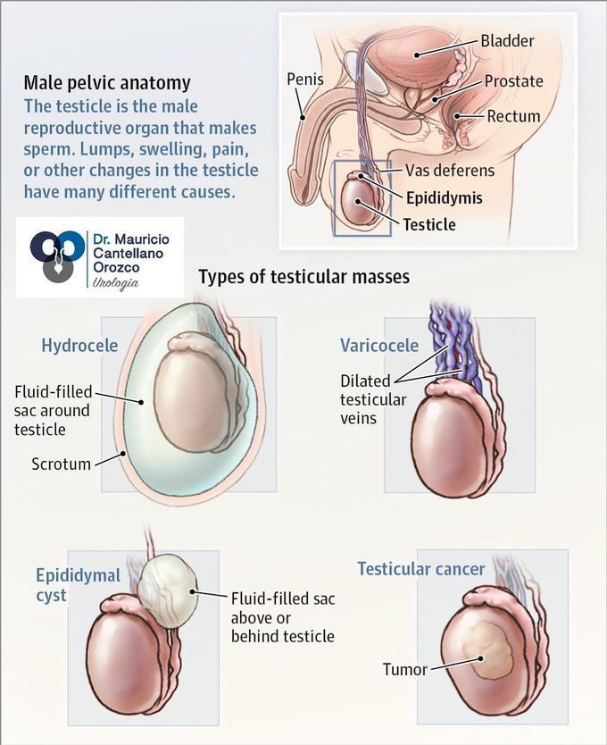 Different type of testicular masses