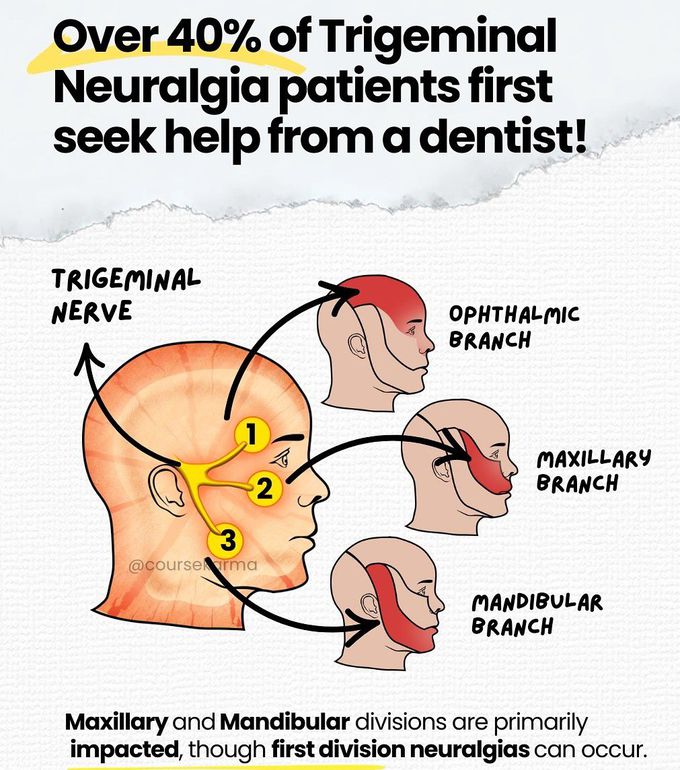 Trigeminal Neuralgia I