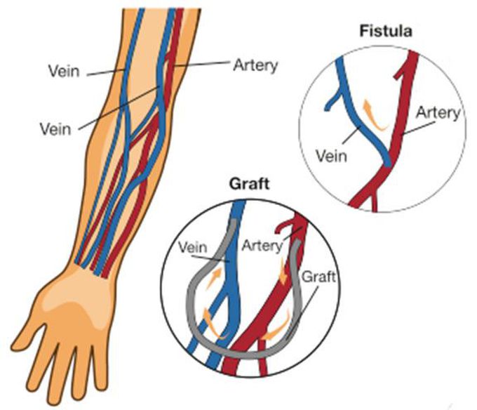 Image: Dialysis Fistulas - Citi Vascular Centre