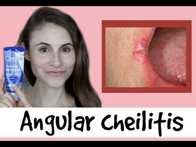 Angular Cheilitis- Causes and Treatments