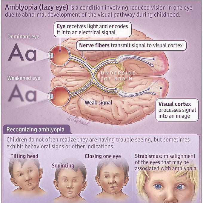 Amblyopia- Lazy eyes