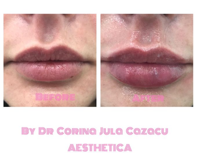 Lip enhancement MEDizzy