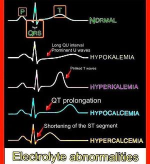 Electrolyte abnormalities in ECG - MEDizzy