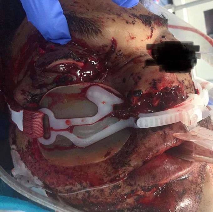 Extensive facial trauma after being ejected from the vehicle!  