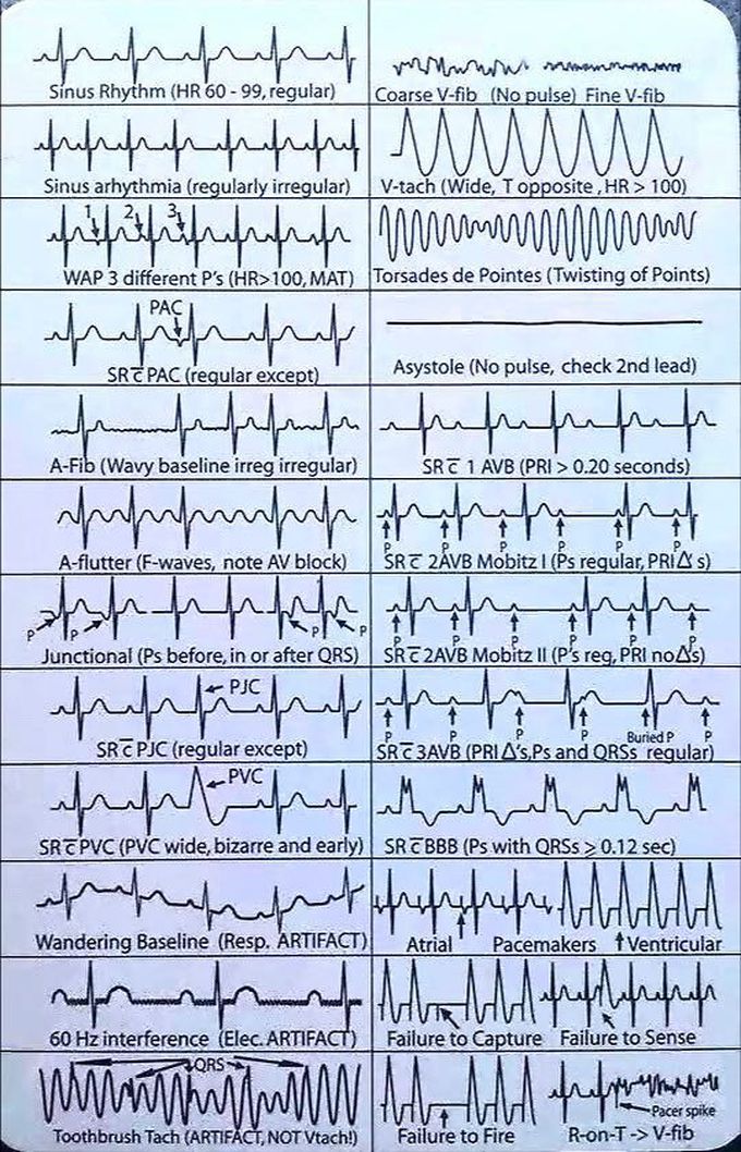 ECG.EKG.elctrochardiogragh