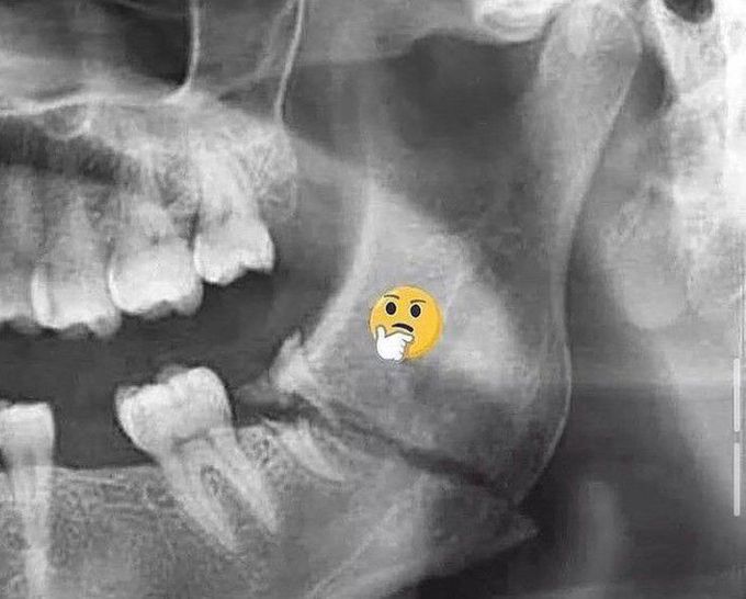 Severe mandibular fracture