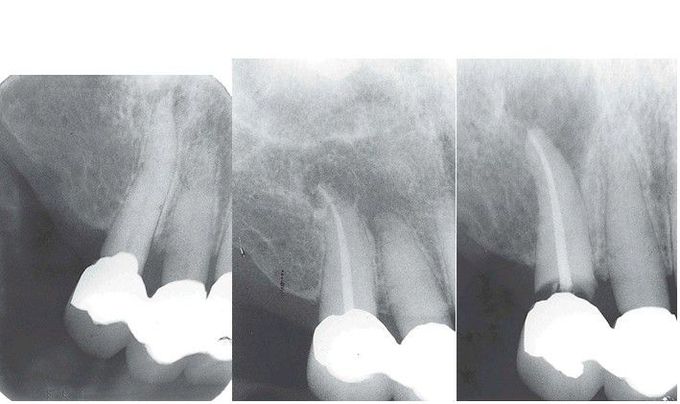 Followup after RCT