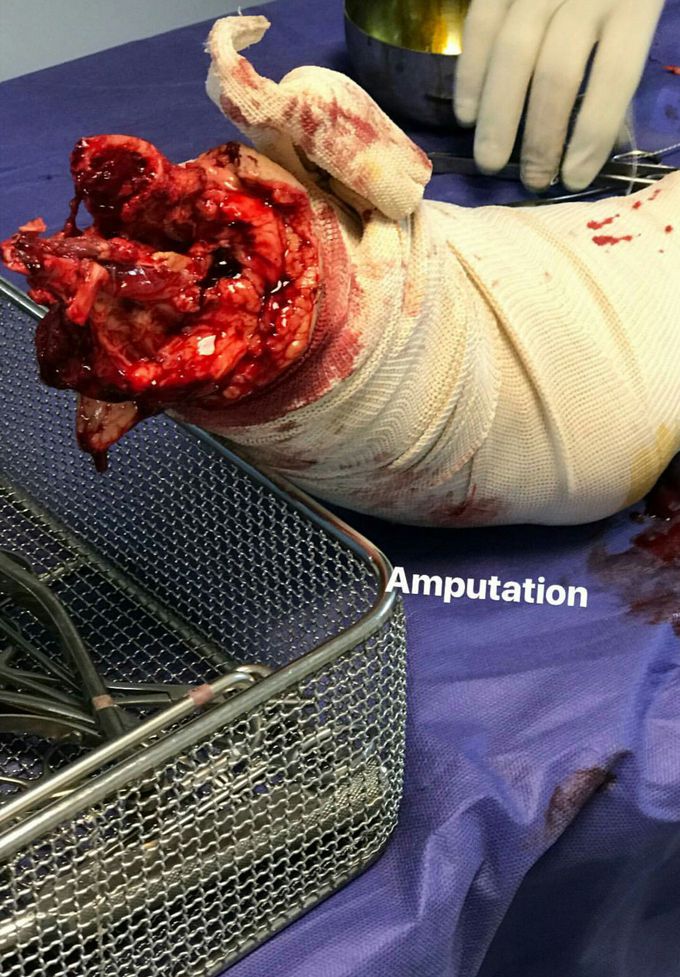 Amputation