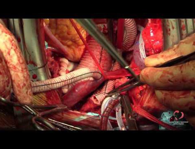 Two-Stage Repair With Classic Elephant Trunk and TEVAR for an Extensive Thoracic Aorta Aneurysm