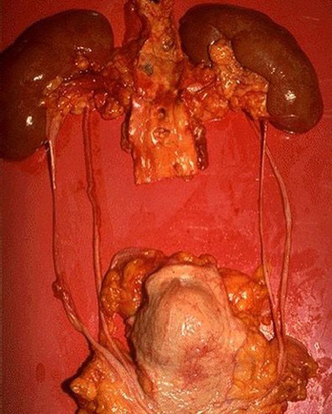 Double the ureters, double the troubles!!!