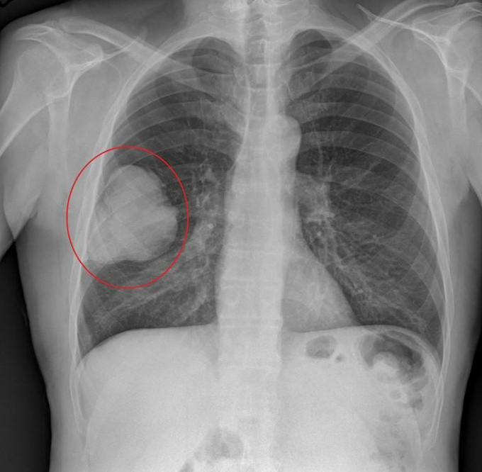 Lung cancer