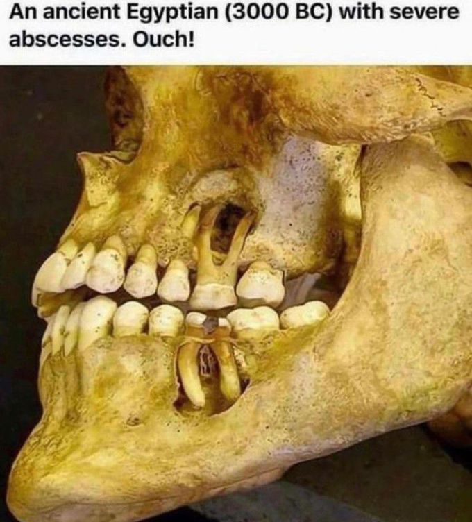 Ancient Egyptian with severe abscess!