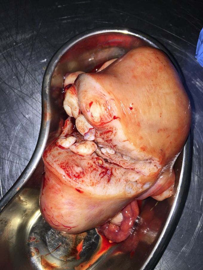 Post op specimen of Fibroid uterus.