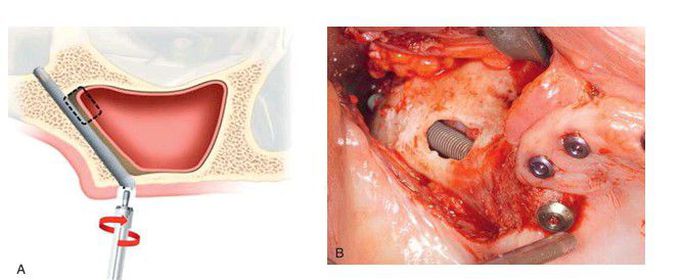 Zygomaticus implant.