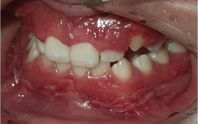 Orofacial Granulomatosis