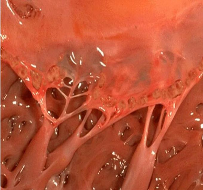 Diagnosis ?