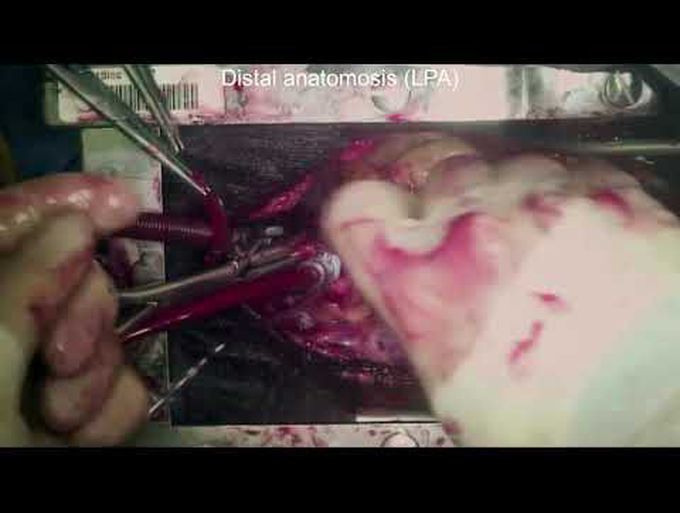 Surgical Treatment of Giant Pulmonary Artery Aneurysm