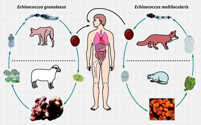 Echinococcosis