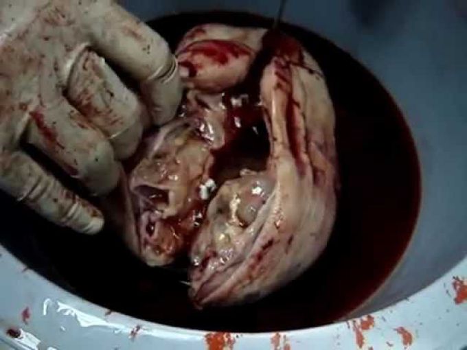 Removal of Large Teratoma