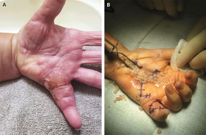 Rice Bodies in Tenosynovitis Due to Psoriatic Arthritis