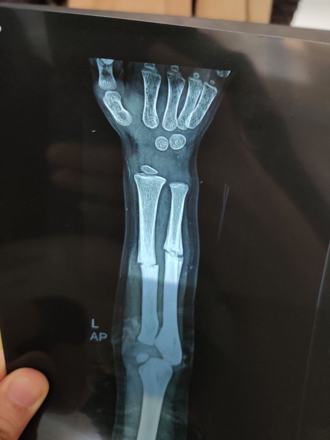 Fracture Radius + Ulna