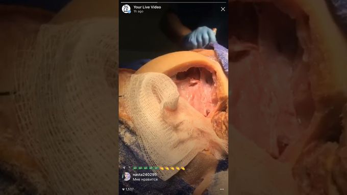 Craniotomy with Filippo Badaloni, MD & Joe Iwanaga, DDS, PhD