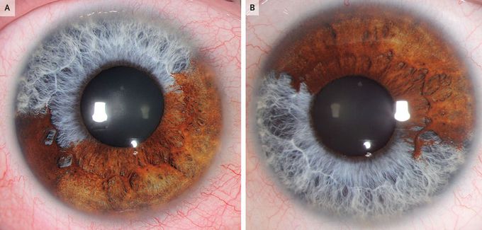 Sectoral Heterochromia