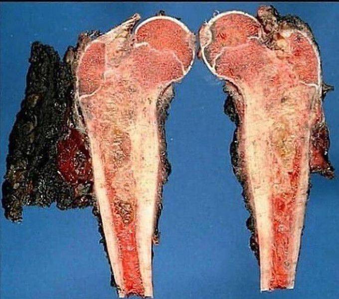 EWING SARCOMA