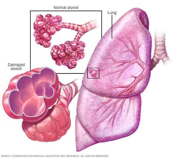 Emphysema - MEDizzy