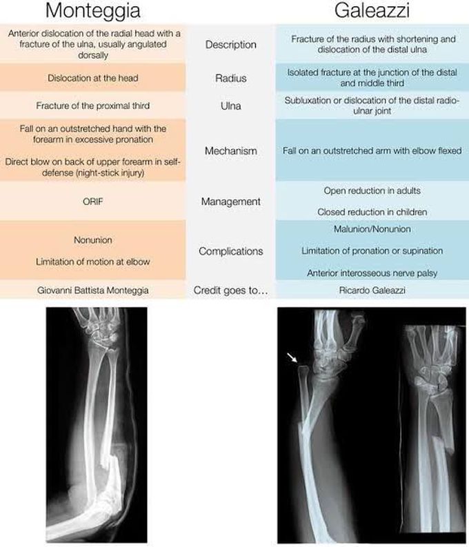 Monteggia and Galeazzi Fracture