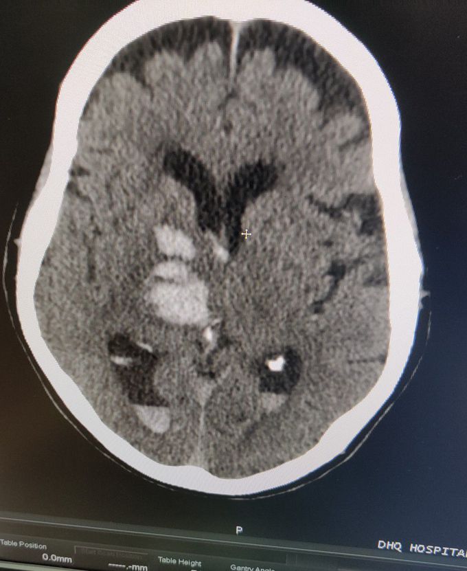 Hemorrhagic CVA