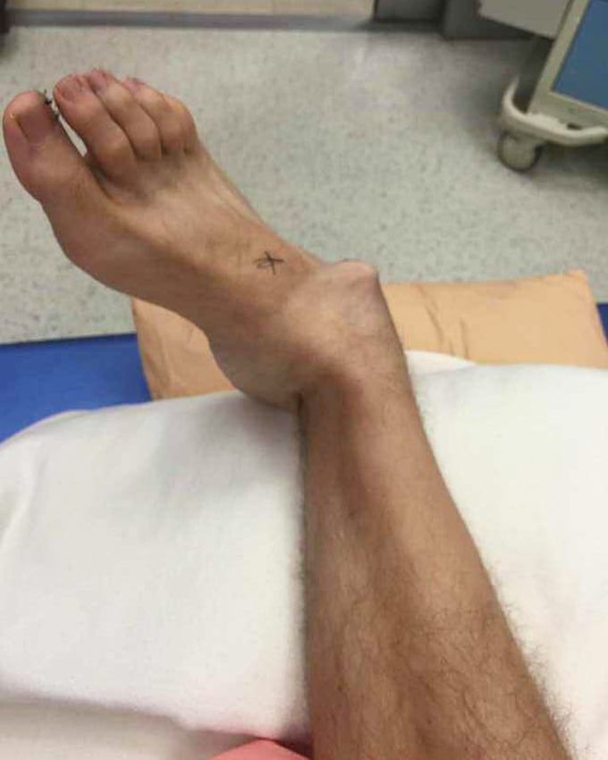 Trampoline accident leaving patient with a dislocated ankle! . 