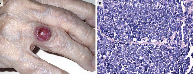 Merkel-Cell Carcinoma