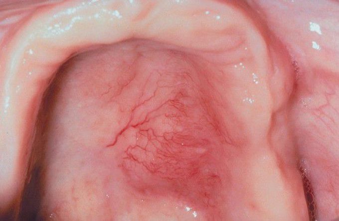 Non-Hodgkin Lymphoma