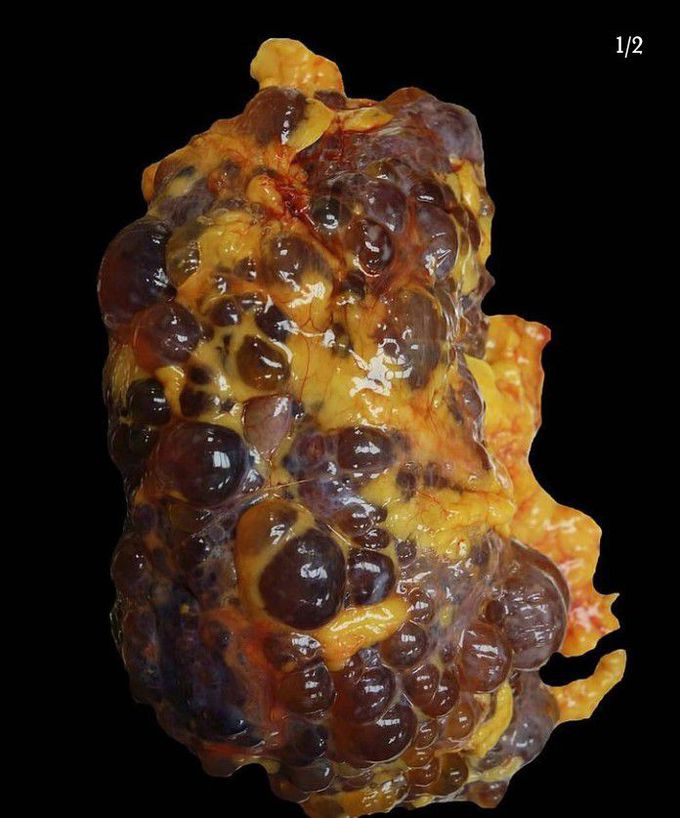 Polycystic kidney Disease