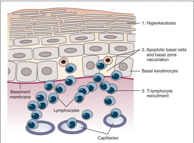 Lichen planus diagnostic features