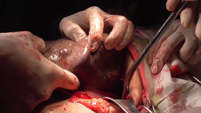 Splenectomy