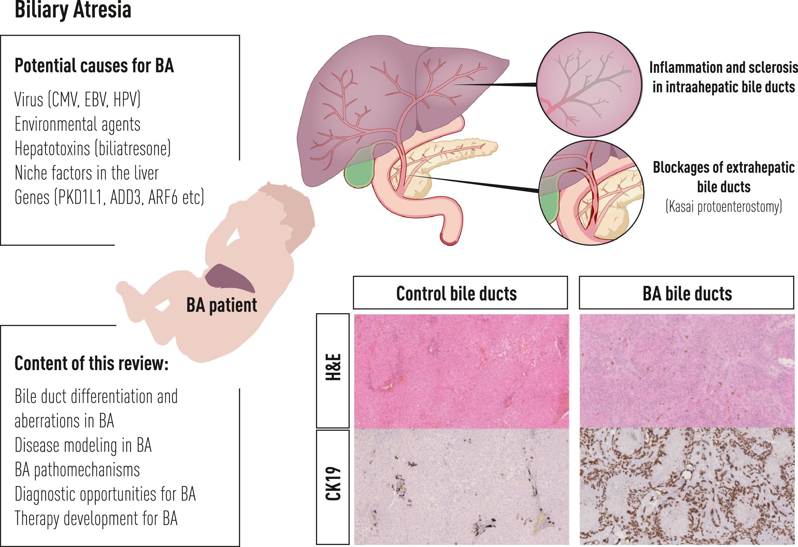 How Serious Is Primary Biliary Cirrhosis