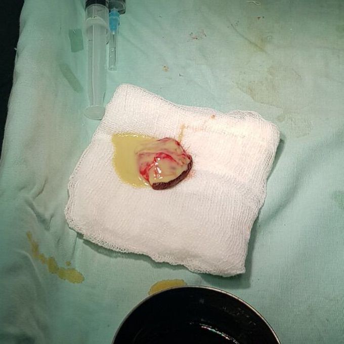 Sebaceous cyst