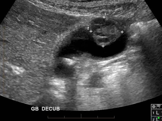 Gall bladder cancer causes