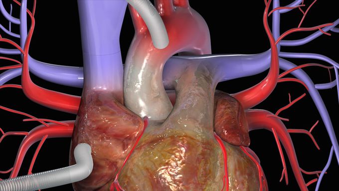Coronary Artery Bypass Surgery(CABG)
